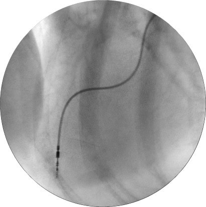 Fluoroscopic image of the heart showing the pacemaker lead in the right ventricle.